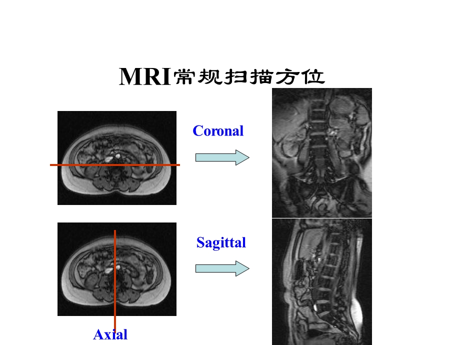 脊柱常见疾病需要MRI诊断ppt课件.ppt_第2页