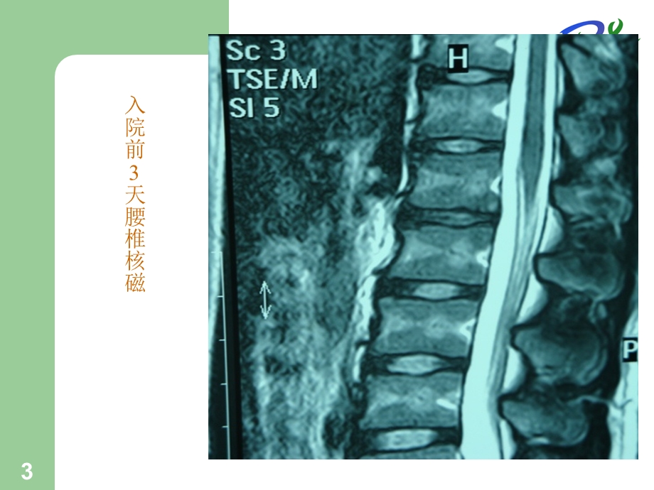 脊髓炎PPT课件.ppt_第3页