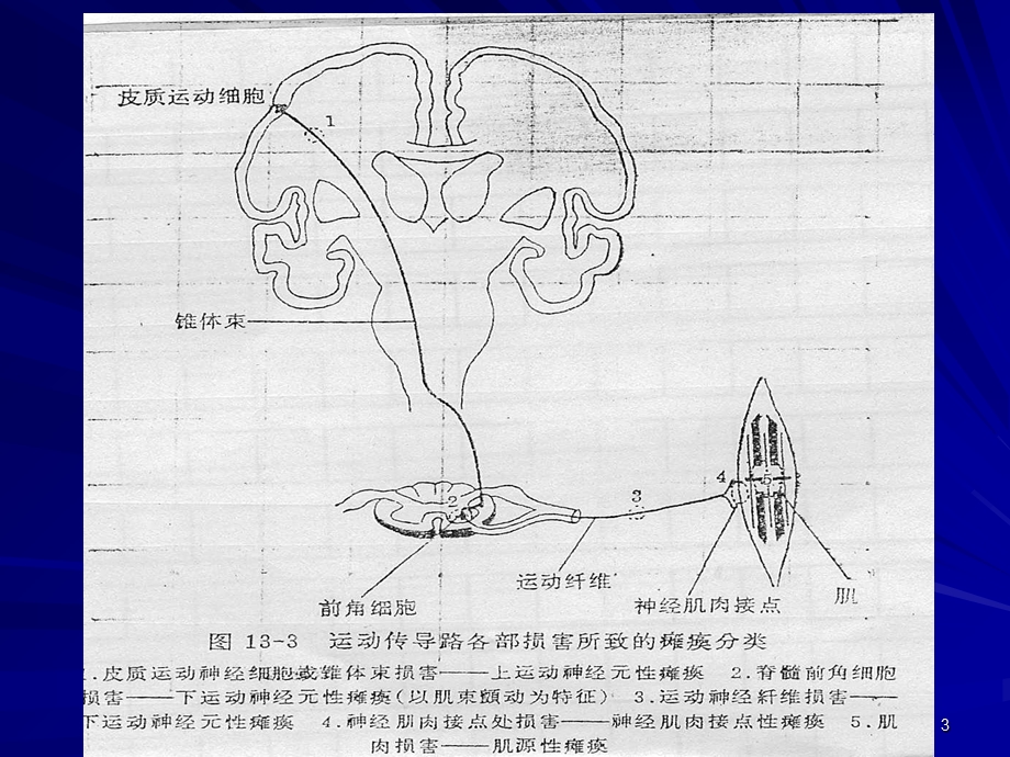 脊髓灰质炎的诊断与鉴别诊断PPT课件.ppt_第3页