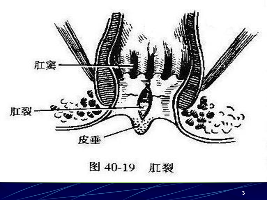 结直肠与肛管疾病之肛管疾病.ppt_第3页