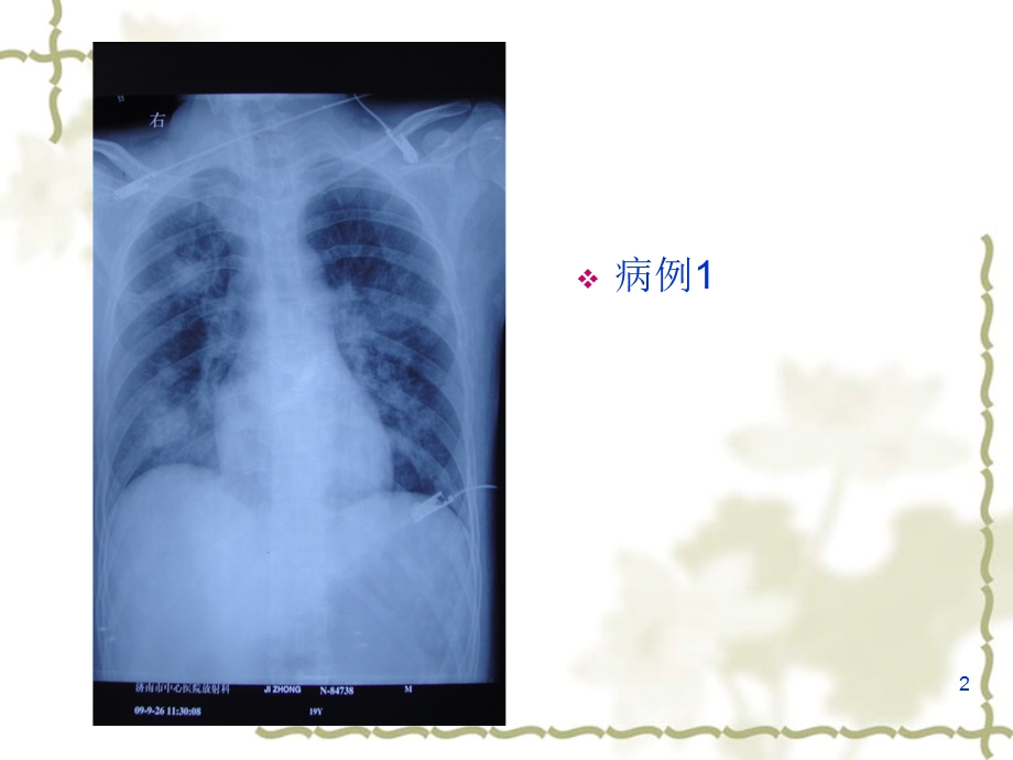 重症甲型H1N1流感的早期诊断.ppt_第2页