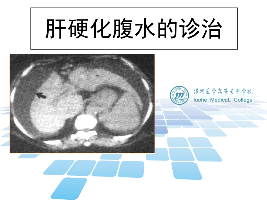 肝硬化腹水的诊治.ppt_第1页