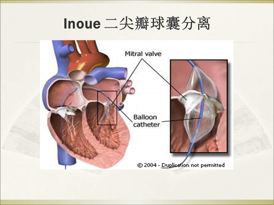 经皮二尖瓣球囊扩张术-经验和教训.ppt_第2页