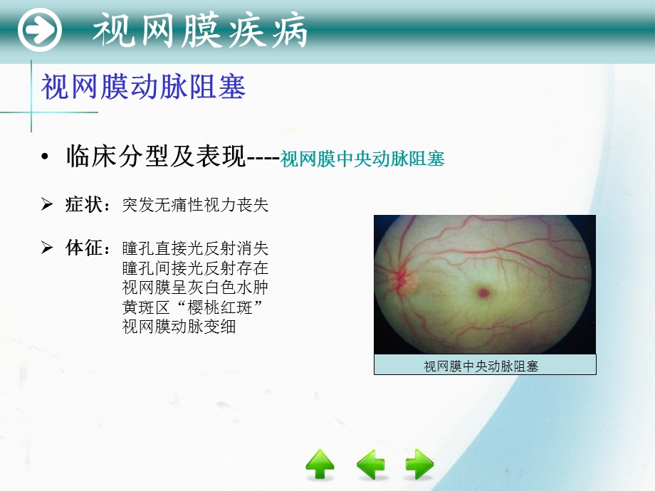 视网膜和视神经疾病.ppt_第3页