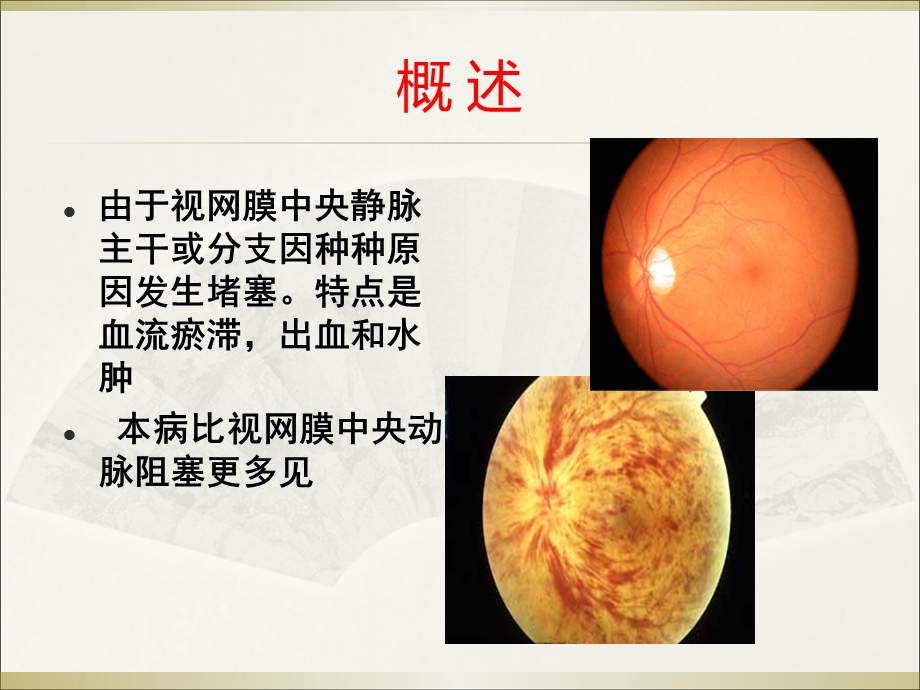 视网膜中央静脉阻塞PPT.ppt_第3页