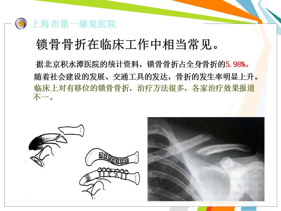 锁骨骨折内固定.ppt_第2页