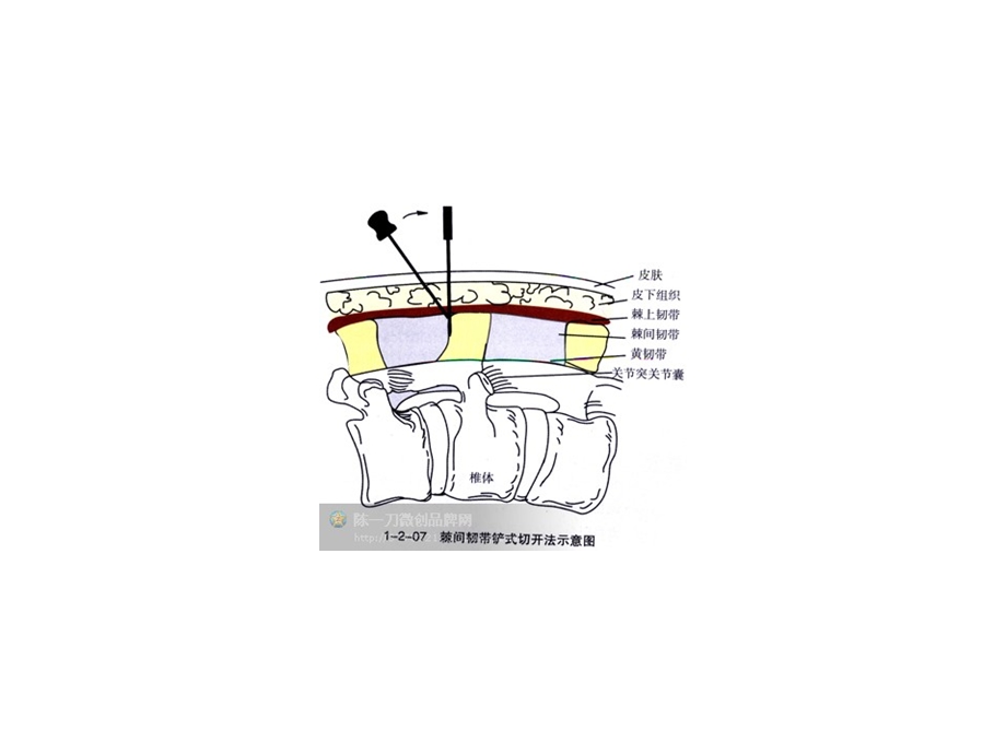 脊柱刀法示意图.ppt_第2页