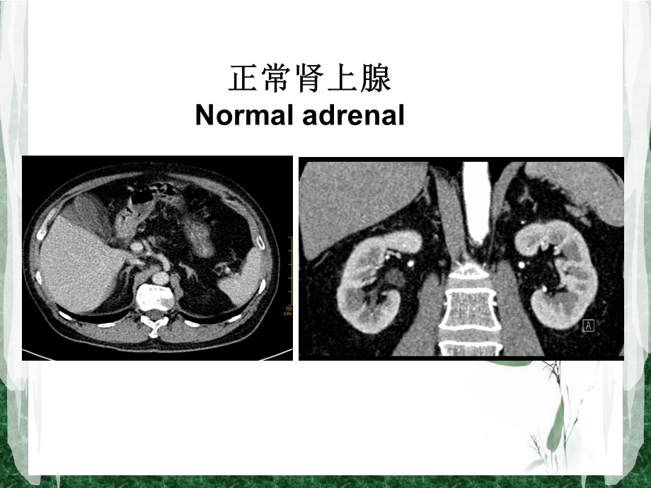 肾上腺静脉分段取血在原发性醛固酮增多症中的应用.ppt_第2页