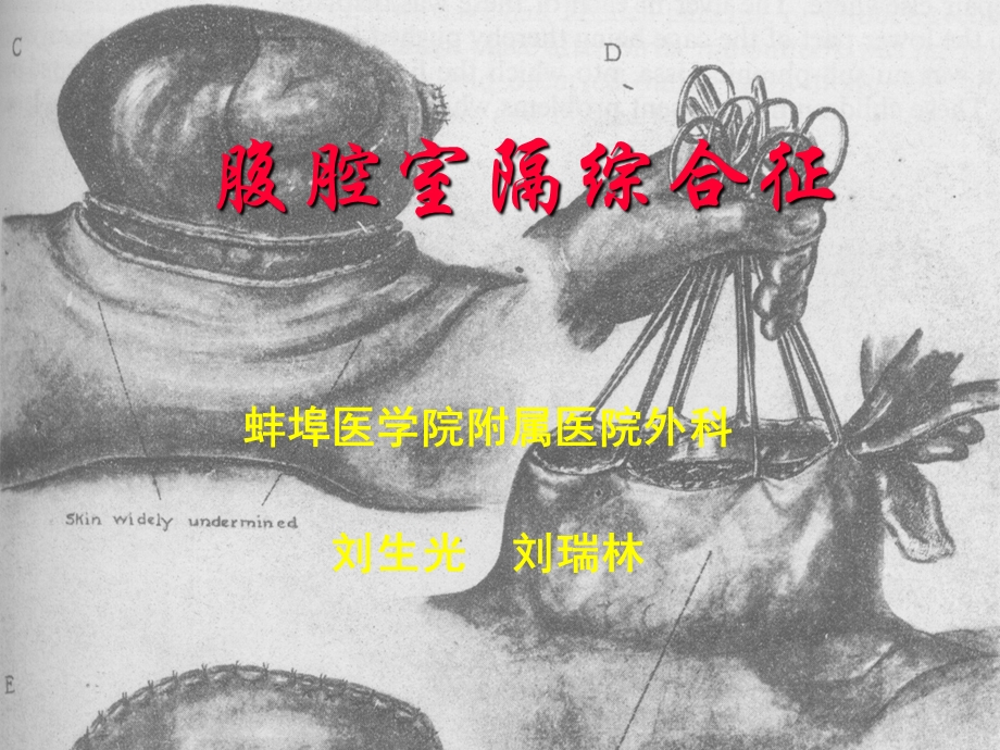 腹腔室隔综合征.ppt_第1页