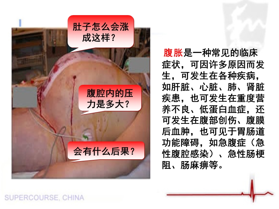 腹腔间室综合征的护理.ppt_第2页