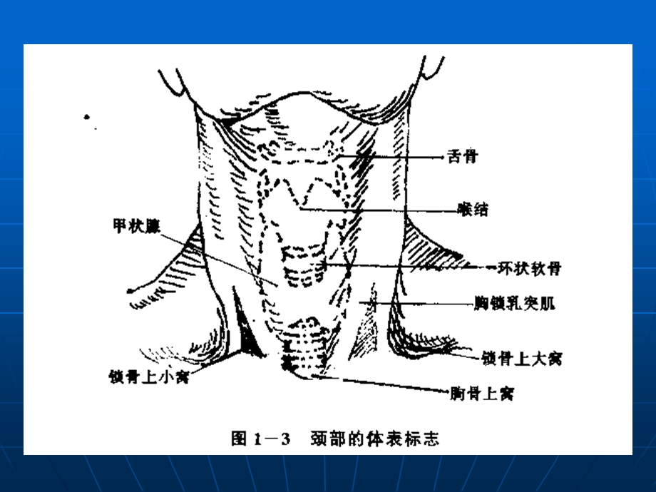 锁骨下深静脉穿刺.ppt_第3页