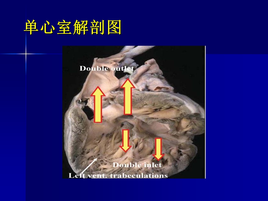 单心室(单一心室房室连接).ppt_第3页