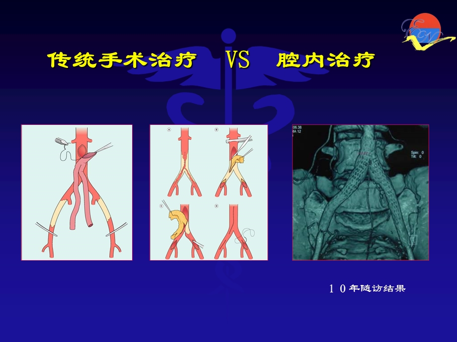 主髂动脉闭塞腔内治疗策略.ppt_第2页