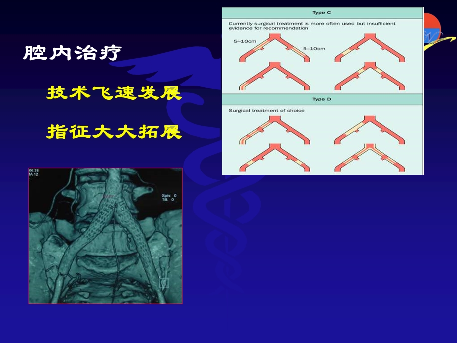 主髂动脉闭塞腔内治疗策略.ppt_第3页