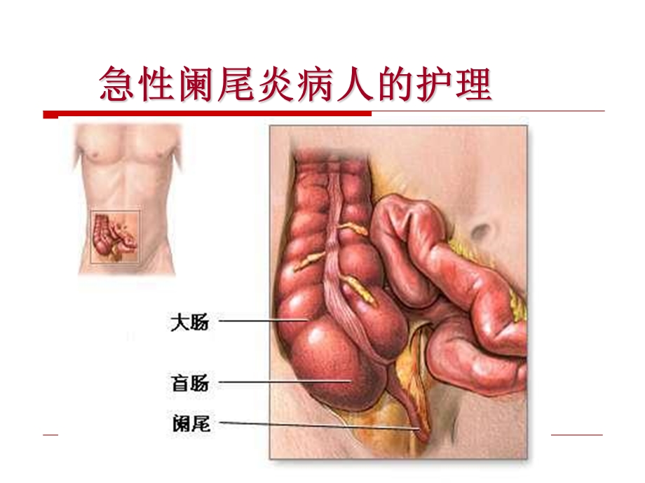 急性阑尾炎病人护理.ppt_第1页