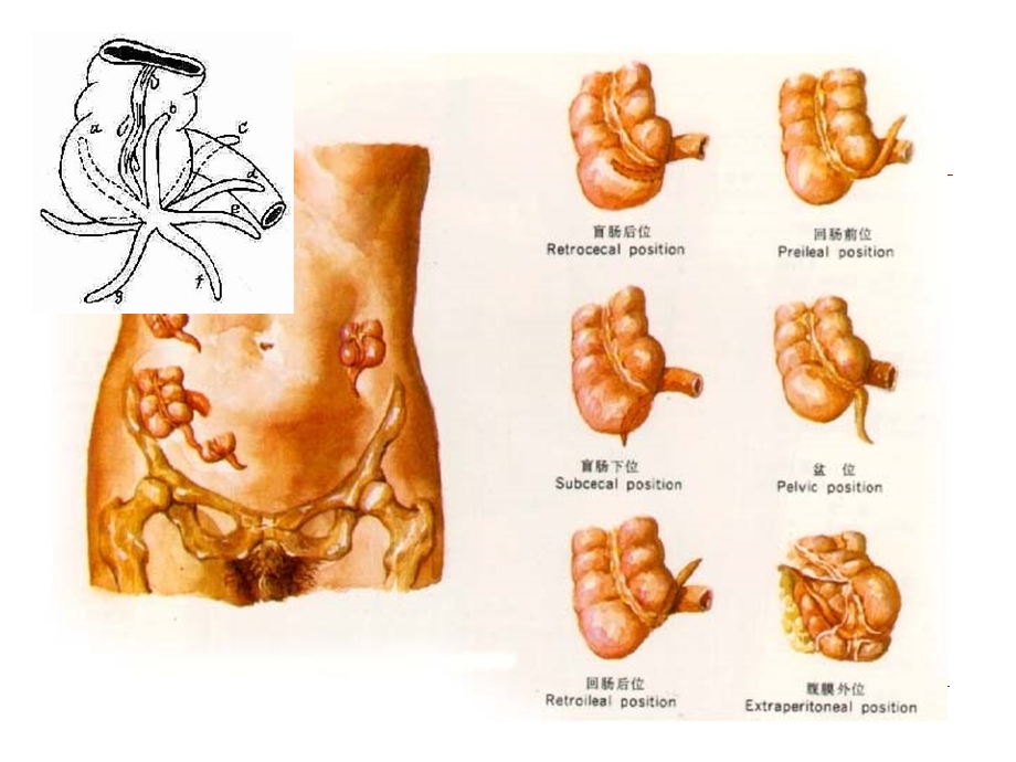 急性阑尾炎病人护理.ppt_第3页