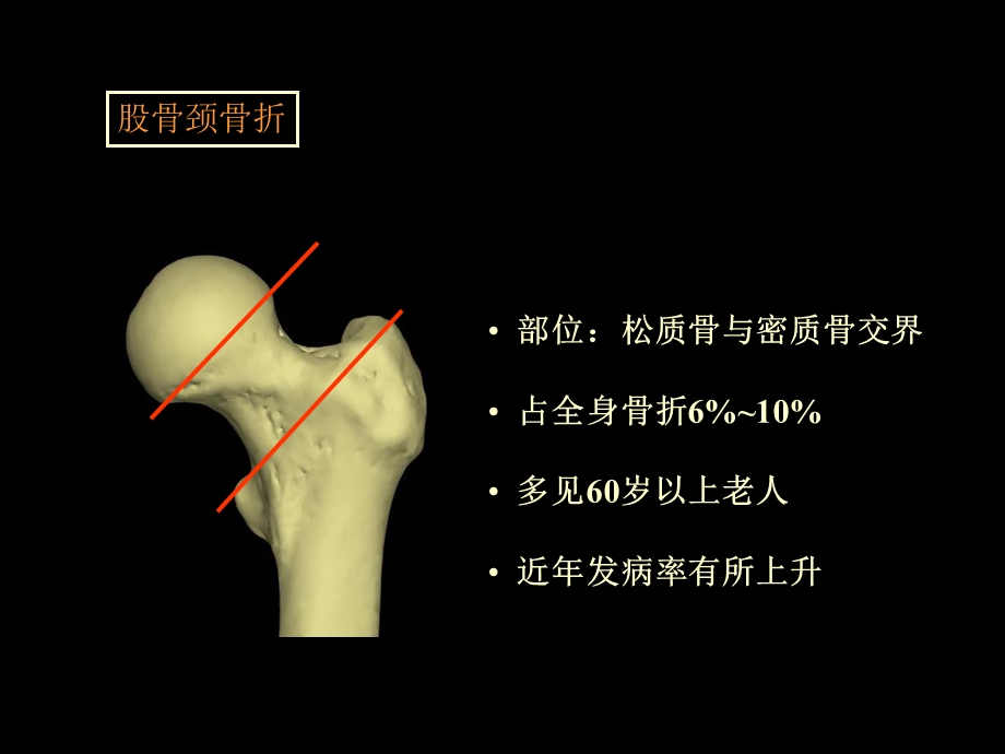 讲课股骨颈骨折PPT课件.ppt_第3页