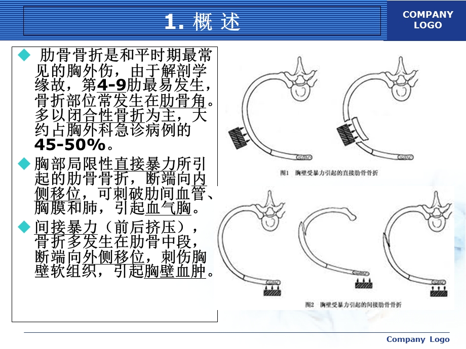 肋骨骨折的外科治疗.ppt_第3页