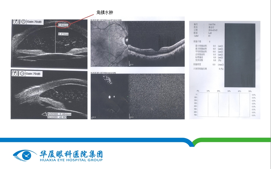 白内障眼内炎.ppt_第3页