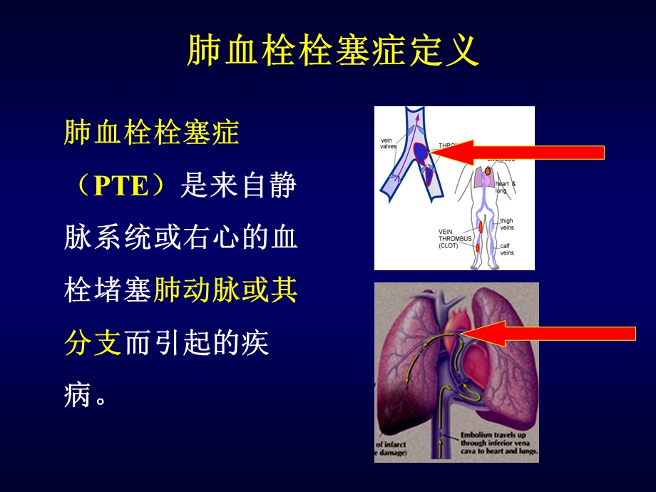 肺栓塞的诊断及防治策略.ppt_第2页