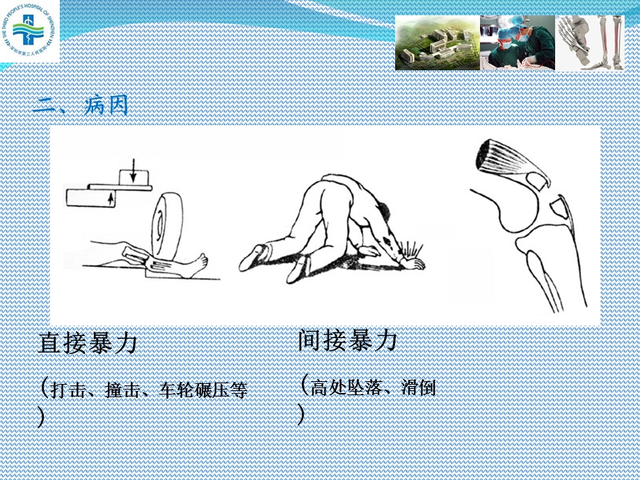 胫腓骨骨折患者查房.ppt_第3页