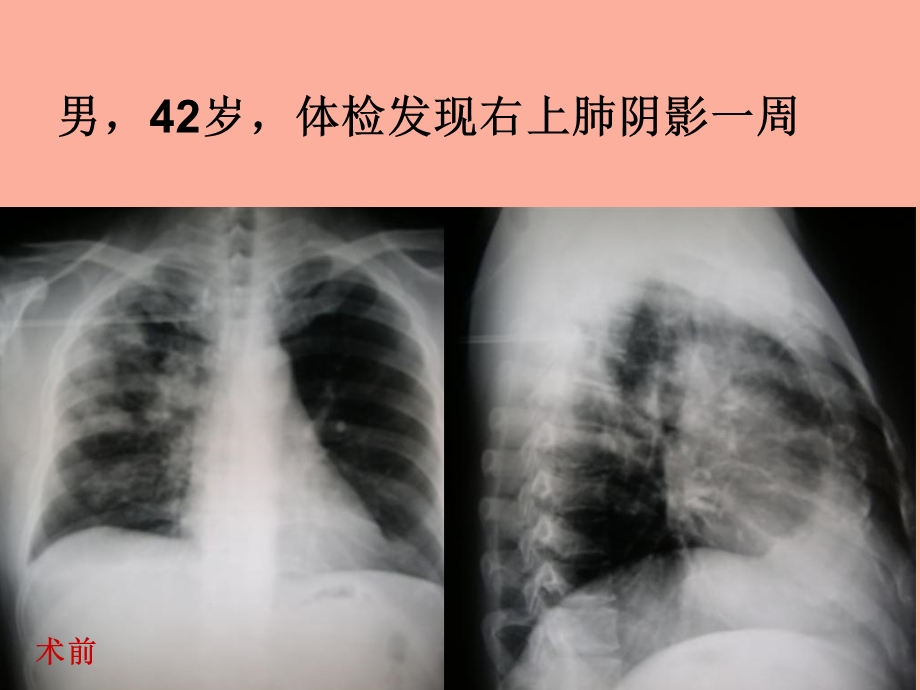 肺隐球菌型肉芽肿.ppt_第2页