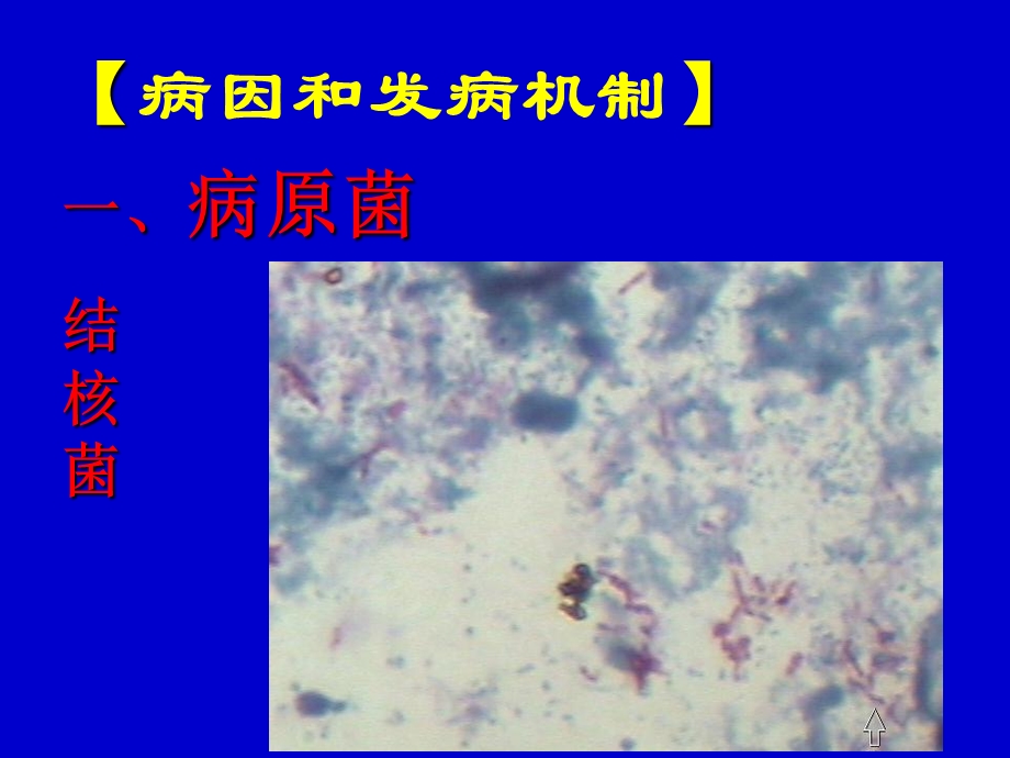 肺结核pulmonarytubercul.ppt_第3页