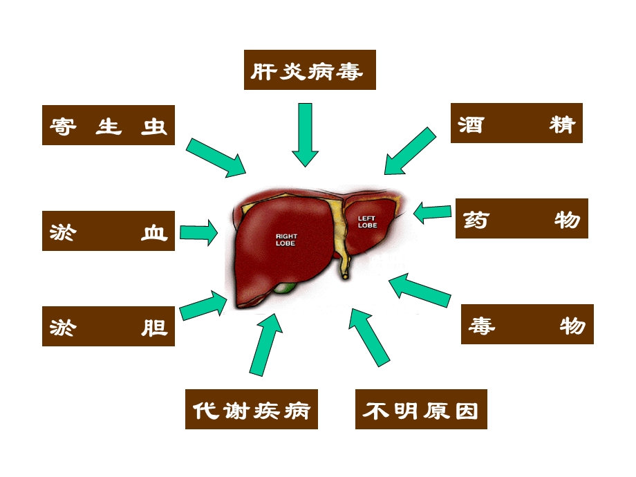 肝硬化是常见的慢性肝病PPT课件.ppt_第3页