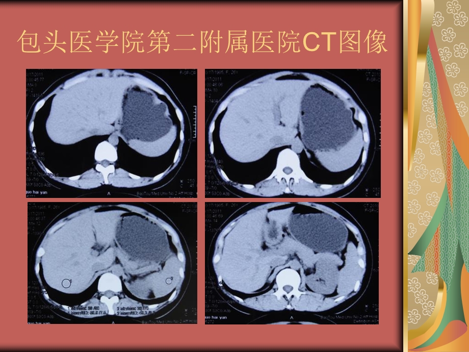 腹膜后非典型性孤立性纤维性肿瘤病例讨论.ppt_第3页