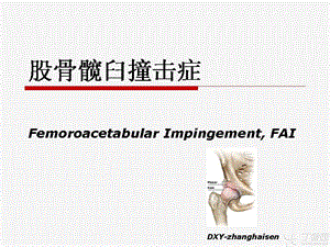 髋臼股骨撞击综合症ppt课件.ppt