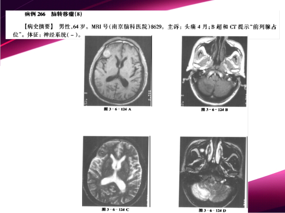 颅内肿瘤MRI诊断.ppt_第3页
