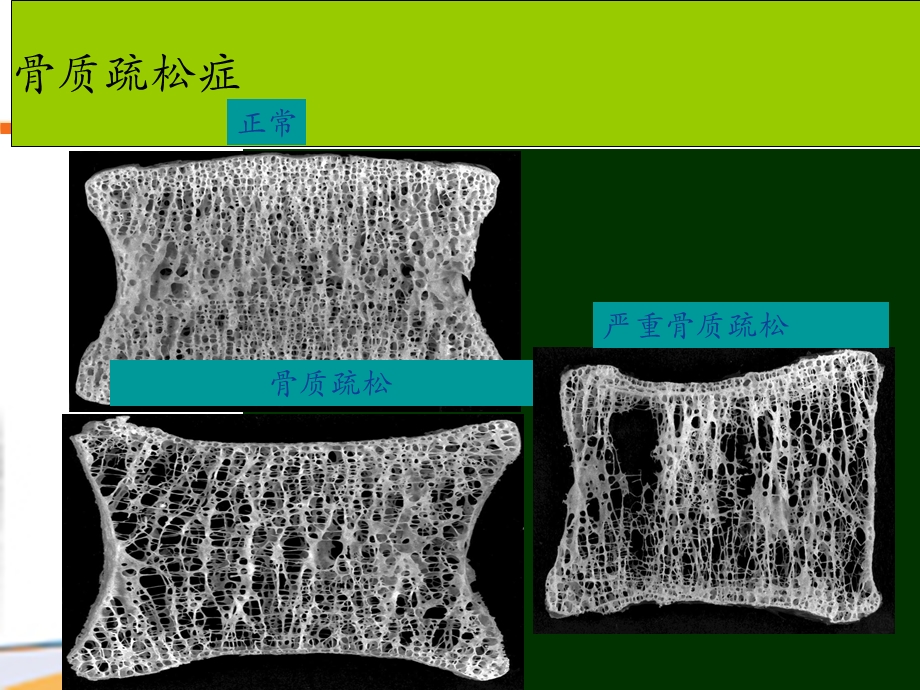 骨质疏松(唑来膦酸安全性O).ppt_第2页