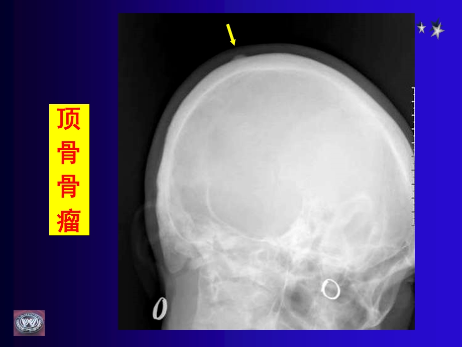 骨肿瘤CT和MRI的影像表现.ppt_第3页