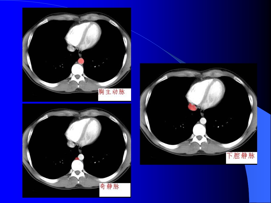 腹部CT诊断(很经典).ppt_第3页