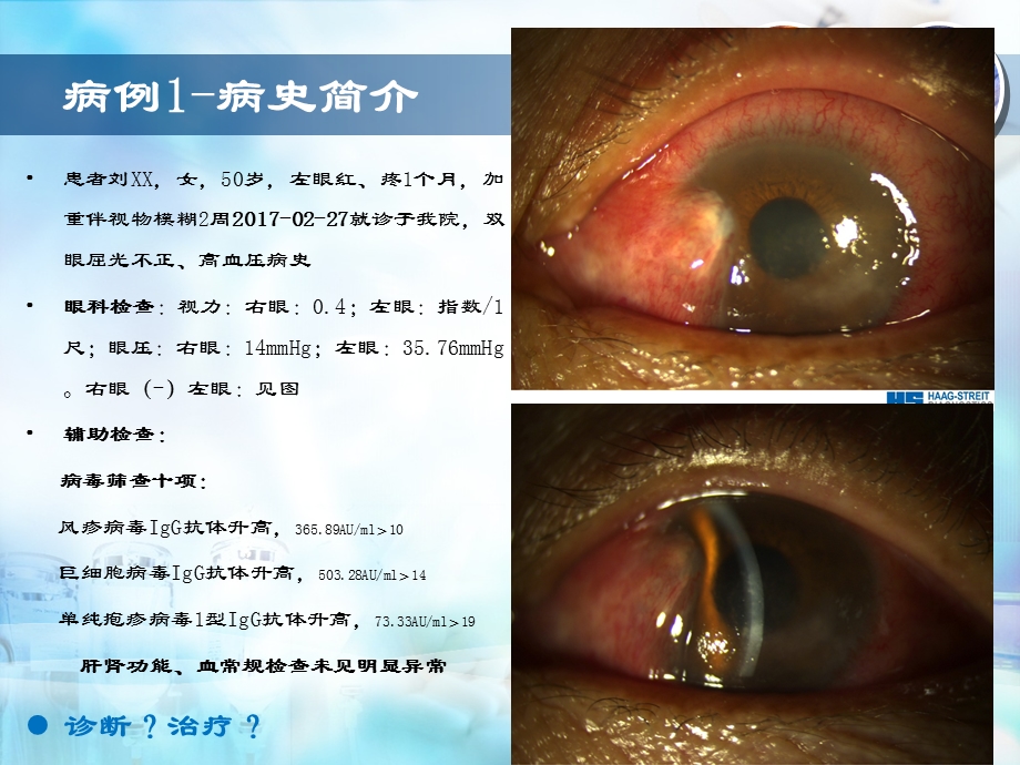 角膜内皮炎的诊断与治疗体会.ppt_第2页