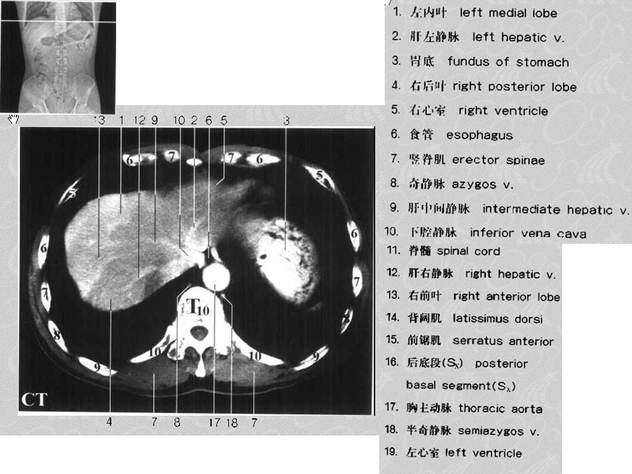 肝脏病变CT诊断.ppt_第3页