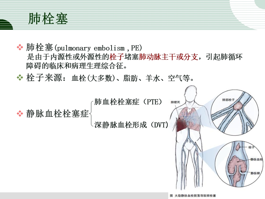 肺栓塞溶栓的护理.ppt_第3页