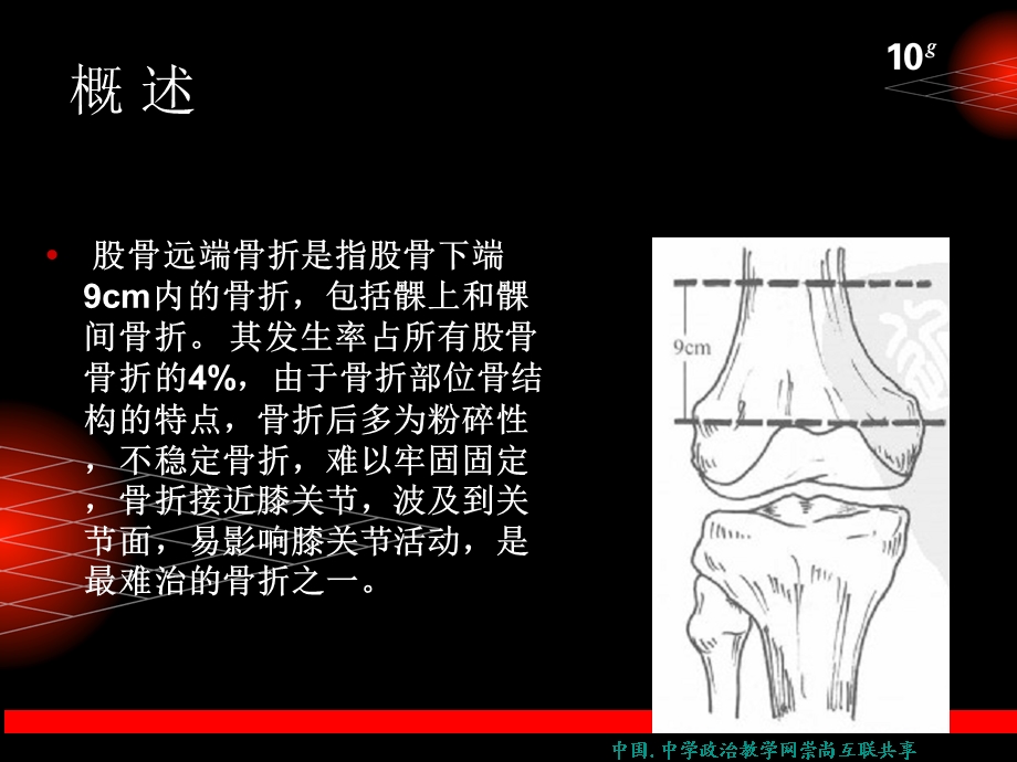 股骨远端骨折临床讲解.ppt_第2页