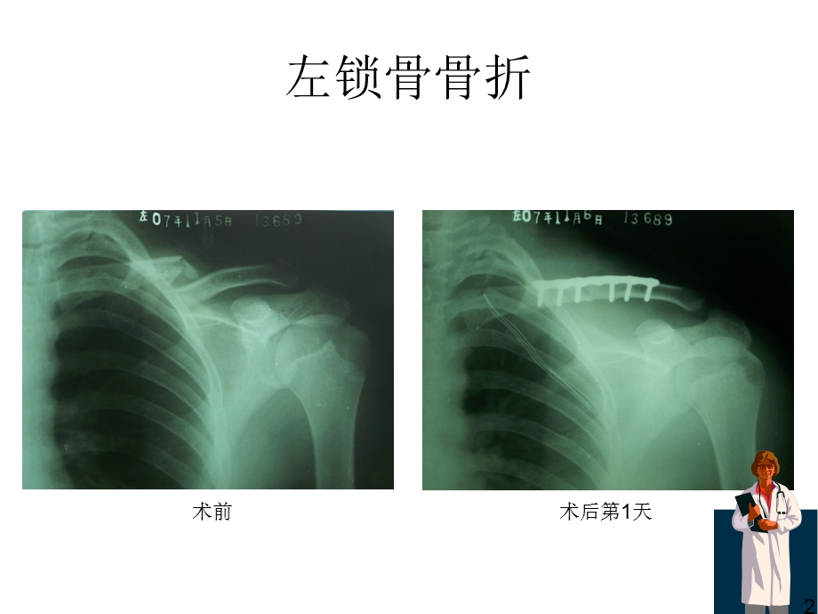 骨折X线片汇总.ppt_第2页