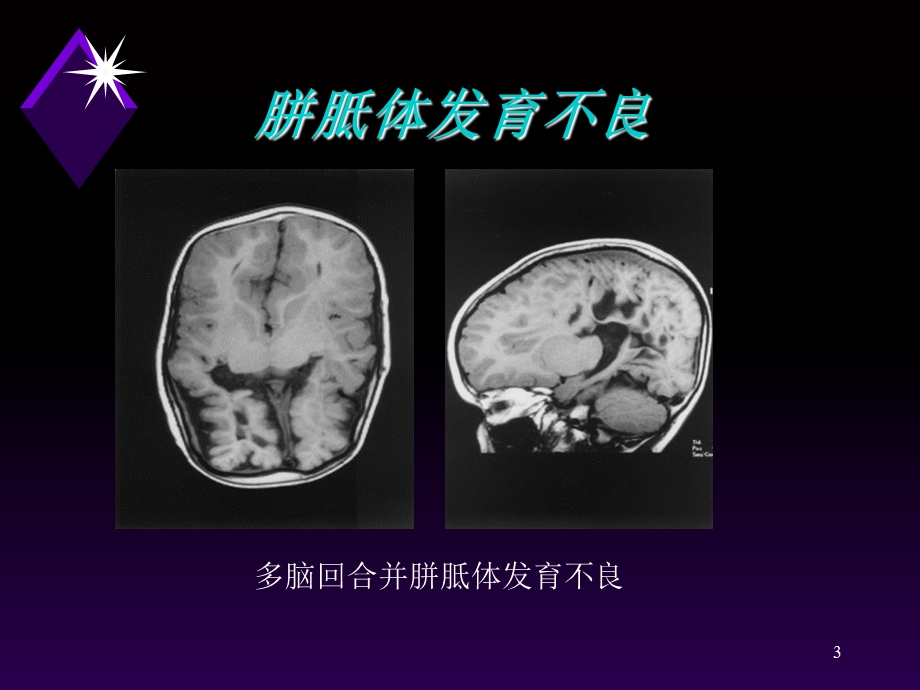 颅脑病变的MRI诊断.ppt_第3页
