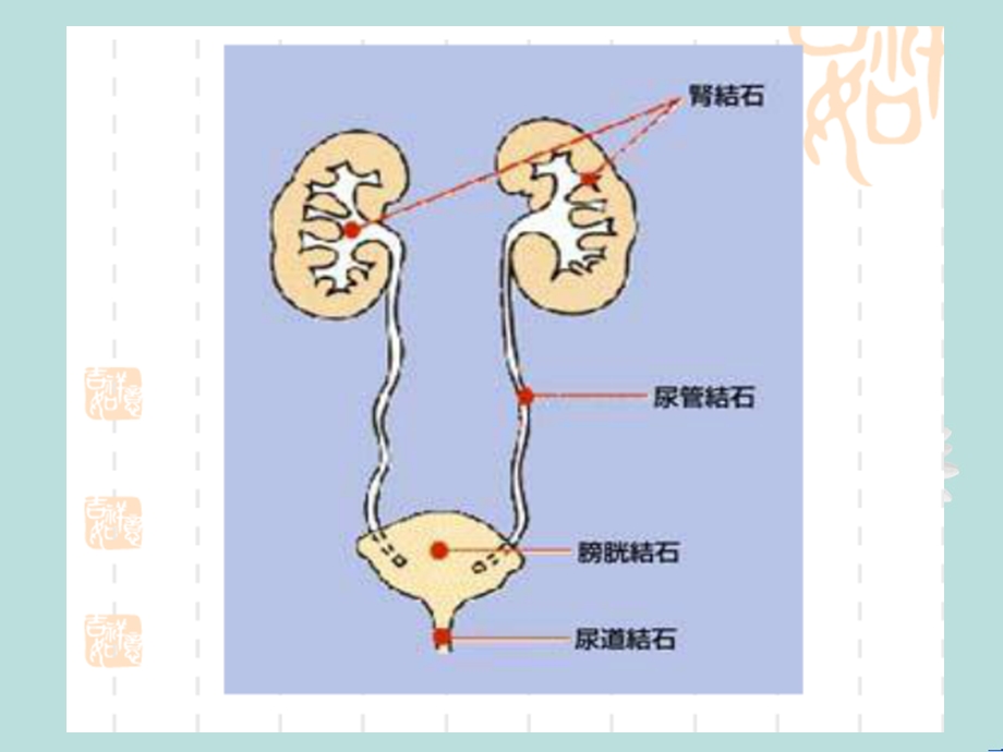 膀胱结石的护理.ppt_第3页