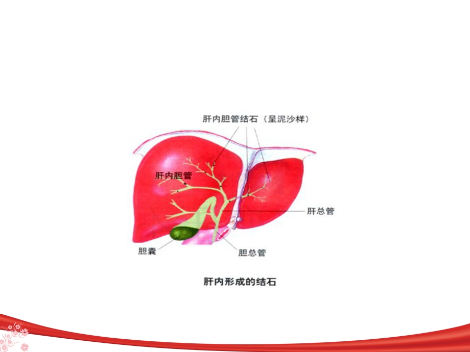 胆管结石的护理.ppt_第3页