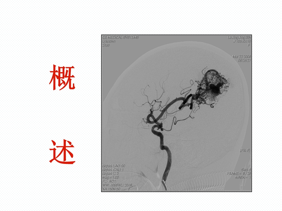 静脉畸形的诊断和治疗.ppt_第2页