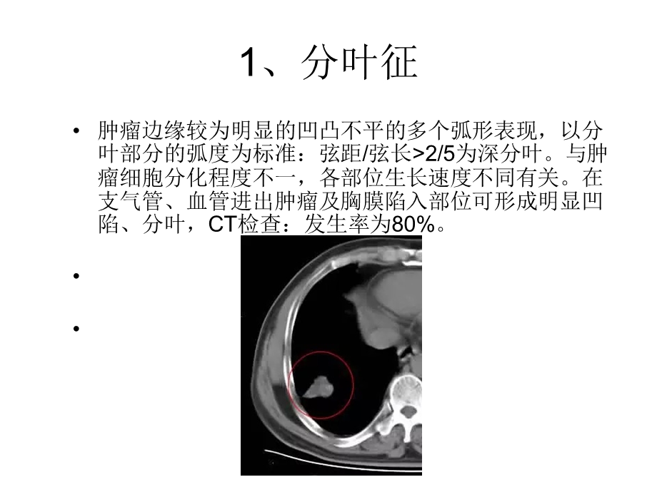 肺癌常见的七大CT影像特征.ppt_第2页