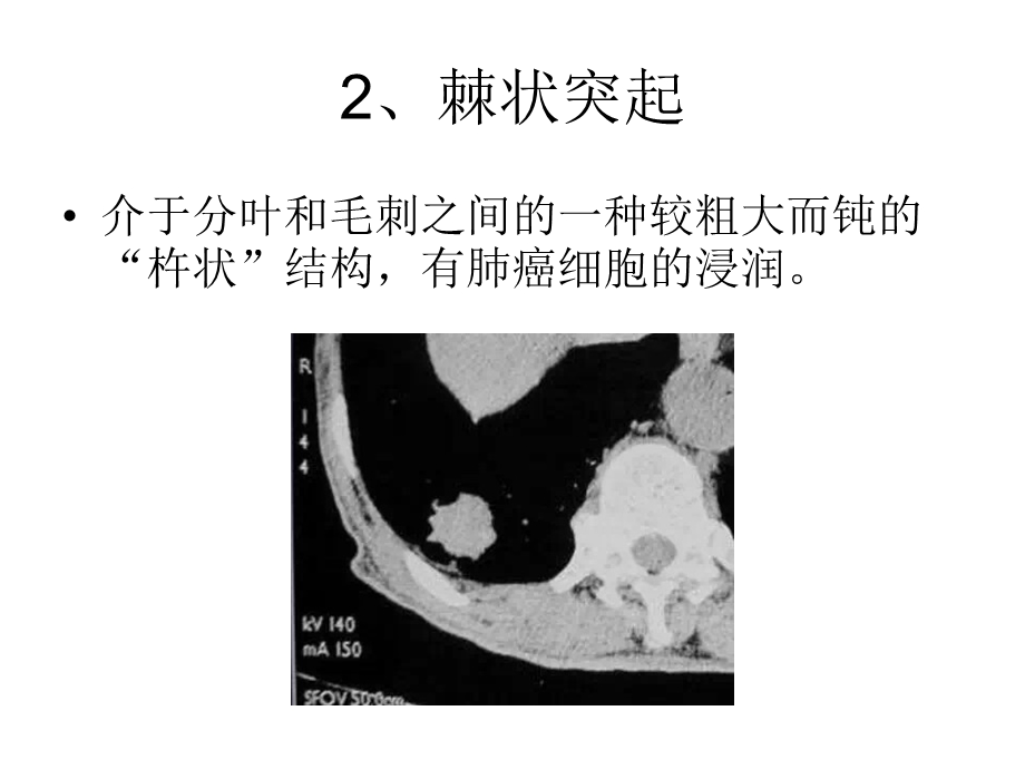 肺癌常见的七大CT影像特征.ppt_第3页