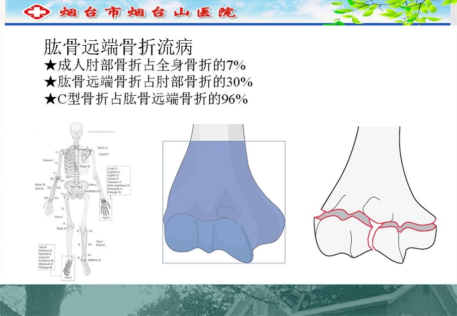 肱骨远端C型骨折的手术入路.ppt_第3页