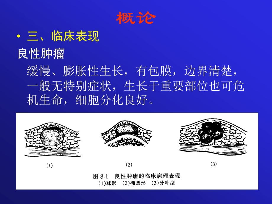 口腔颌面部常见肿瘤ppt课件.ppt_第3页