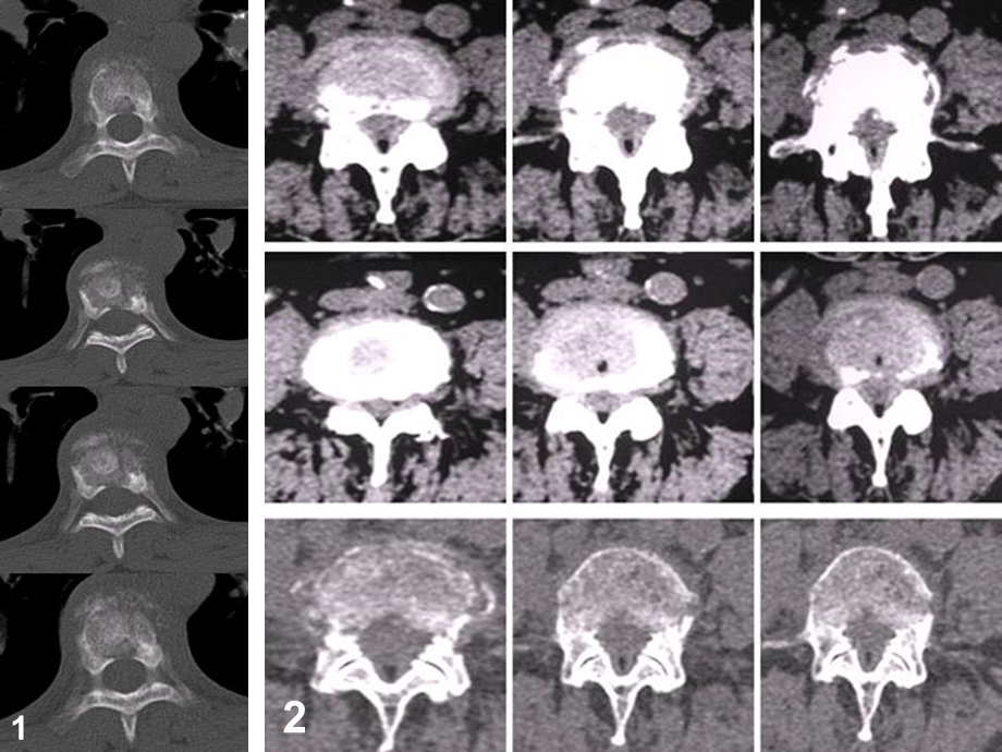 多层螺旋CT在脊柱病变诊断中的应用.ppt_第2页