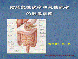 结肠良性狭窄和恶性狭窄的影像表现.ppt