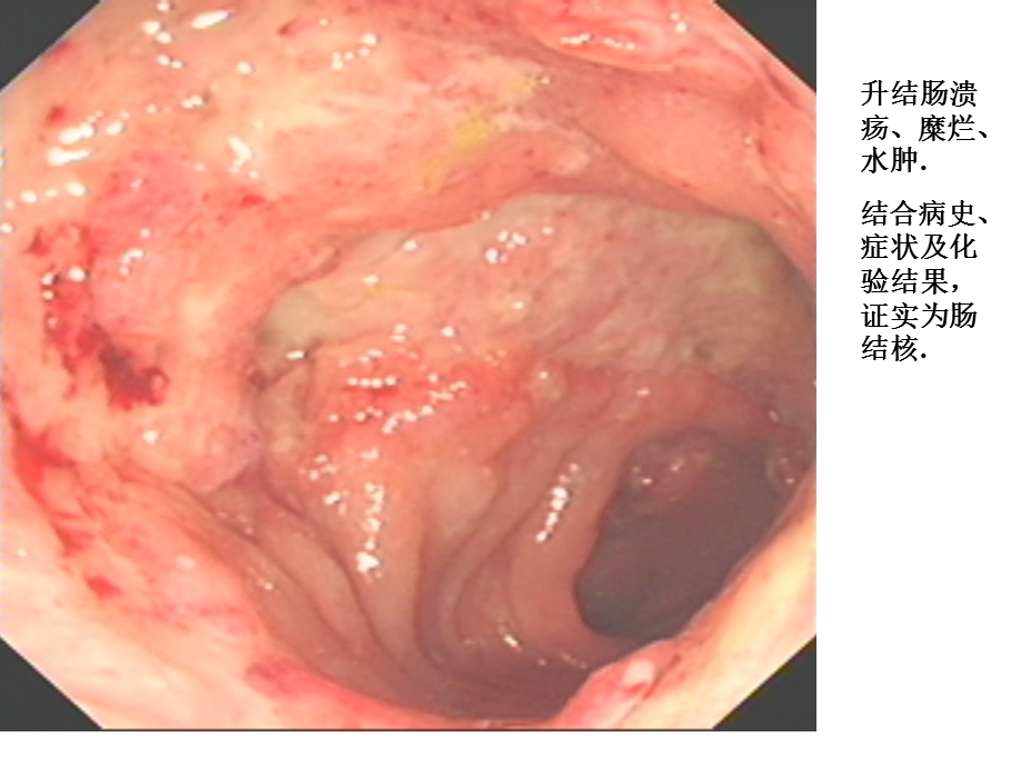 腹部结核多媒体.ppt_第2页